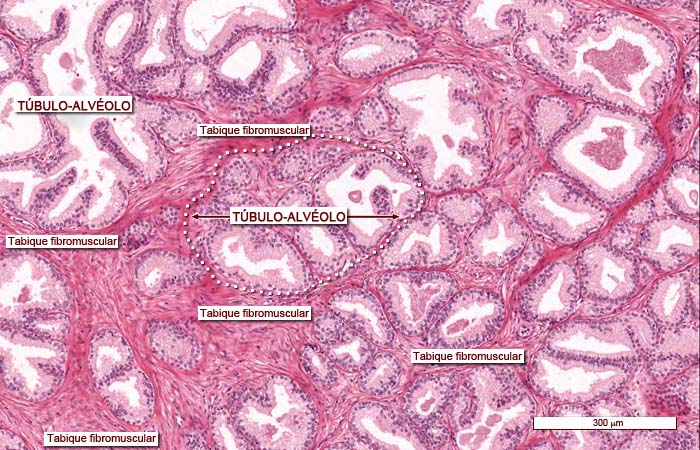 Cancer de prostata histologia, Puncție-Biopsie Mamară cu ac gros eco-ghidată (TRU-CUT)