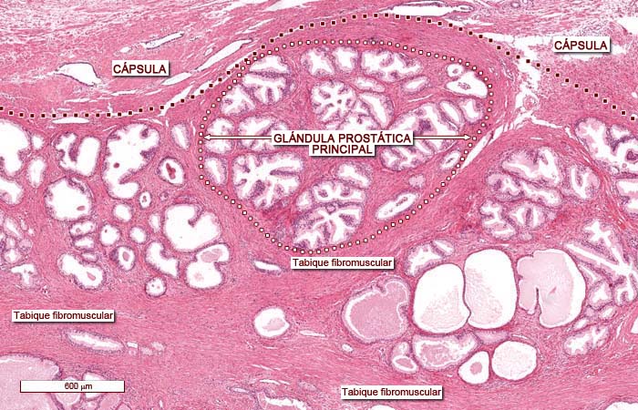 Cancer de prostata histologia, Puncție-Biopsie Mamară cu ac gros eco-ghidată (TRU-CUT)