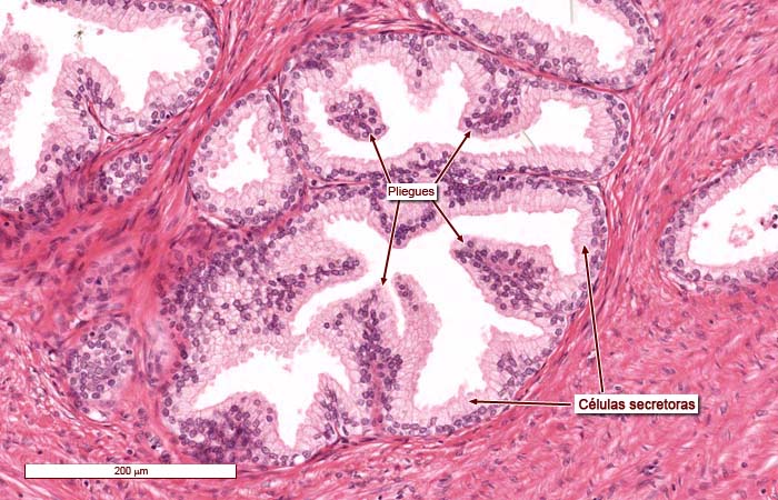 Cancer de prostata histologia, Modul de procesare a papilomelor la distanță